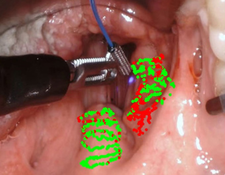 A close-up image of a tumor being operated on. Digital red and green dots cover areas of the cancerous tissue.