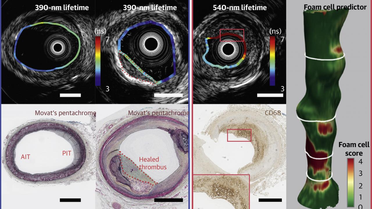 Central illustration showing use of FLIm in arteries